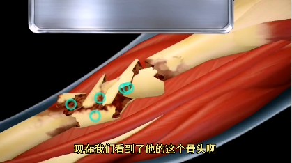 骨折手术模拟器游戏官方手机版图4: