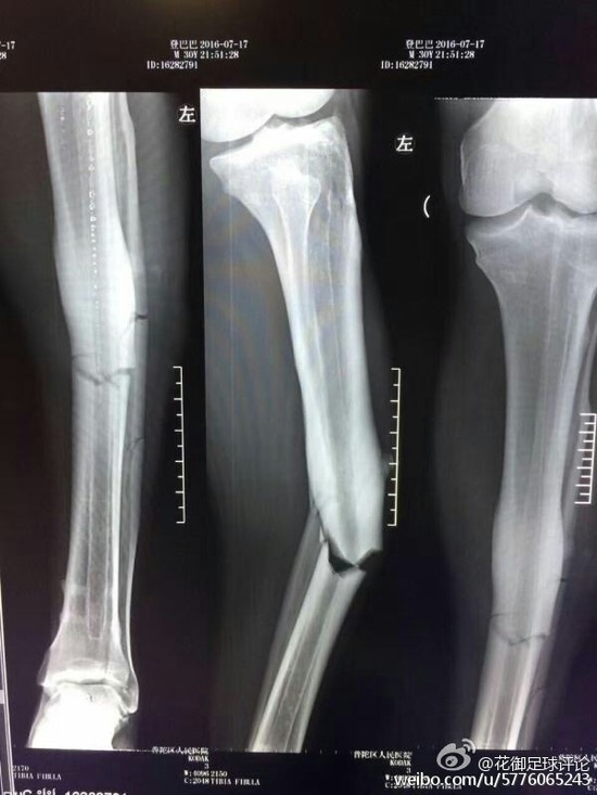 惨 登巴巴x光照曝光左腿胫骨腓骨全部骨折 周边 游戏鸟